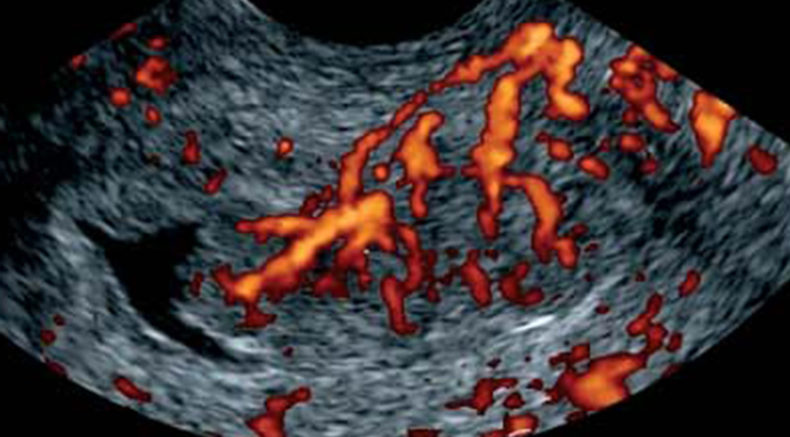  Gyne course endometrial tumoral vascularization_ multiple focal vessels.jpg