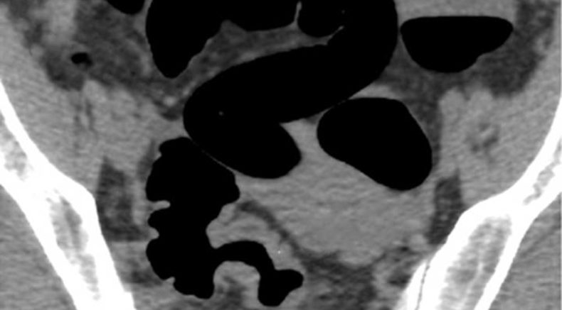 Endometriosis course 1 