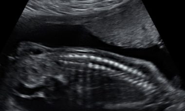 Sac teratoma main pic.jpg