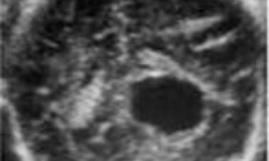 Intracranial cyst main pic.JPG