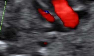 interrupted aortic arch.jpg