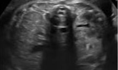 Unilateral renal agenesis main pic.JPG