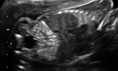 Echogenic bowel main pic.jpg
