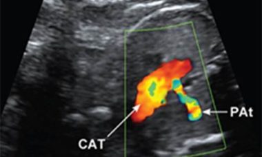 Truncus arteriousus.jpg Fetal anomalies 2017