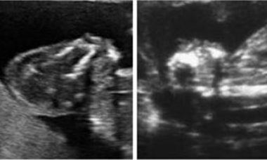 anencephaly main pic.JPG