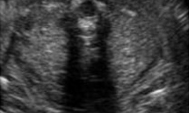 Bilateral renal agenesis main pic.JPG