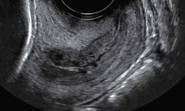Transvaginal ultrasound_cervix.png