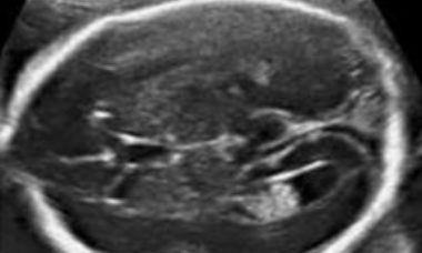 Abnormal ventricles main pic.JPG