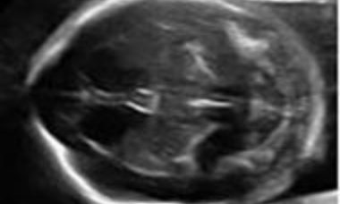 Spina bifida main pic.JPG