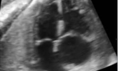 Ventricular septal defects main pic.JPG