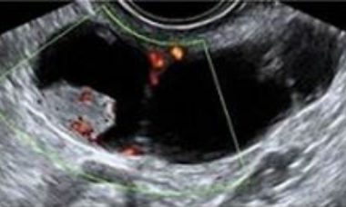 Pulmonary carcinoma of the fallopian tub main pic.JPG