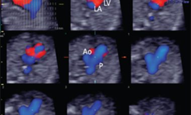 Cardiac exam w STIC.jpg Fetal anomalies 2017