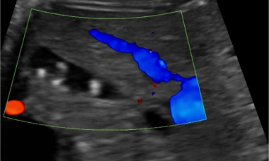 Fetal gallstones main pic.png