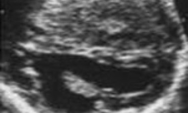 Schizencephaly main pic.JPG
