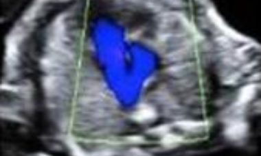 Abnormal 3-vessels view main pic.JPG