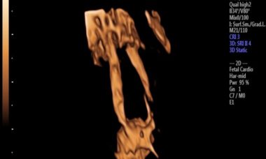 Choledochal Cysts.jpg
