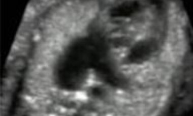 Absent pulmonary valve syndrome main pic.JPG