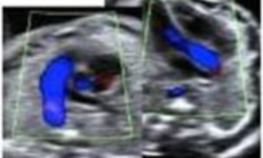 Abnormal outflow tracts main pic.JPG