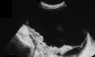 Brenner tumor main pic.jpg