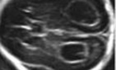 Chorois plexus cysts main pic.JPG