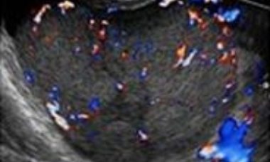 Ovarian dysgerminoma main pic.JPG