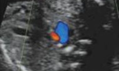 Pulmonary artresia main pic.JPG