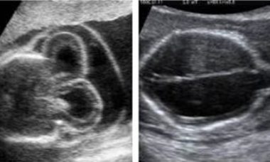 Cephalocele main pic.JPG