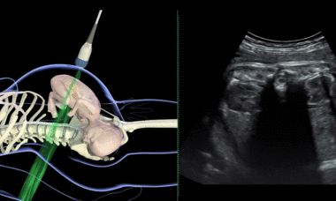 Fetal ultrasound in labor