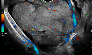 clear cells carcinoma main pic.png