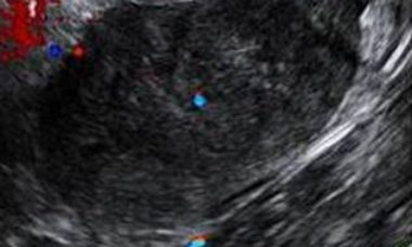 Ovarian fibroma and fibrothecoma main pic.JPG