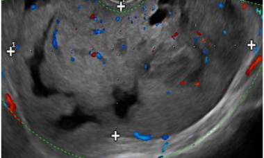 Endometrioid main pic.png