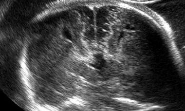 microcephaly scan.jpg