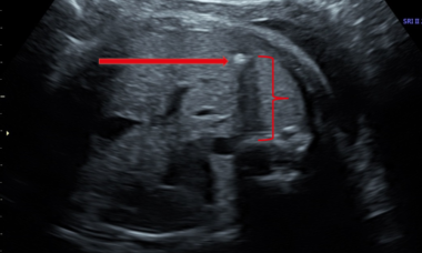 Hepatic calcifications main pic.png