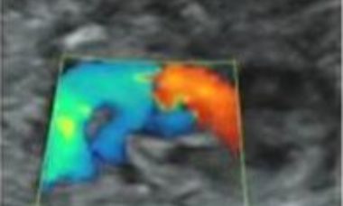 Common arterial trunk main pic.JPG