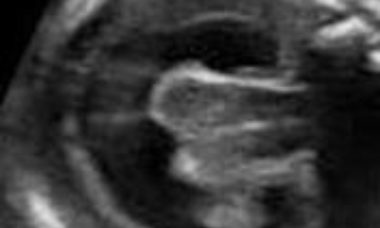 Holoprosencephaly title image.jpg