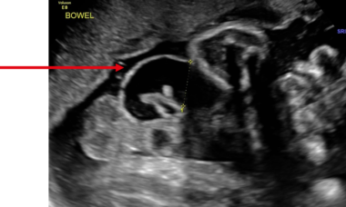 Gastrochisis lead pic.png