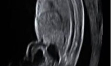 Abnormal bladder main pic.JPG