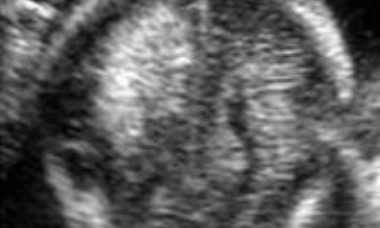 Echogenic - complex mass main pic.JPG