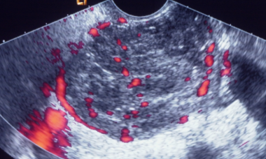 Sertoli cell tumor.png