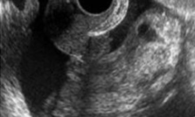 Malignant struma ovarii main pic.JPG