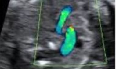 Tetralogy of Fallot main pic.JPG
