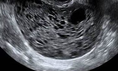 Granulaosa cells tumours main pic.JPG