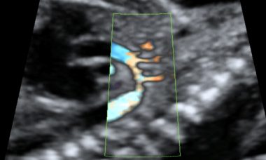 Coaractation of the aorta.png