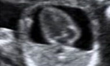 Pericardial effusion main pic.JPG