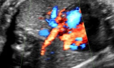 Scimitar syndrome - main pic.jpg