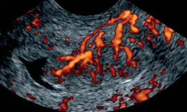  Gyne course endometrial tumoral vascularization_ multiple focal vessels.jpg