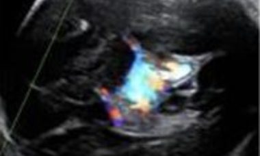 Enlargement of the vein of galen main pic.JPG