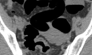 Endometriosis course 1 