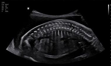 Fetal Spine with Luminant.jpeg 3