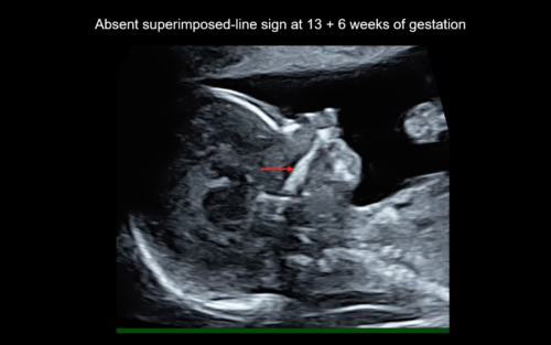 UOG video clip: Absent ‘superimposed‐line’ sign: novel marker in early ...